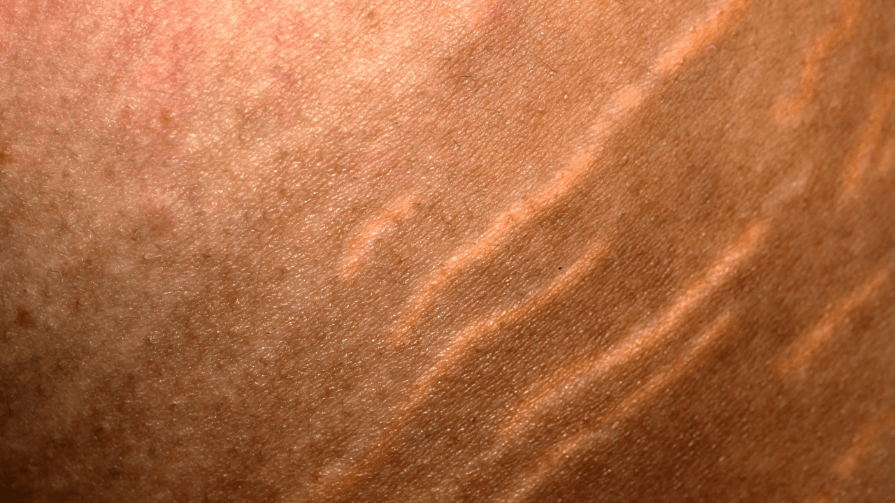 ‘The results can be amazing’ – Irish aesthetician explains how to treat stretch marks