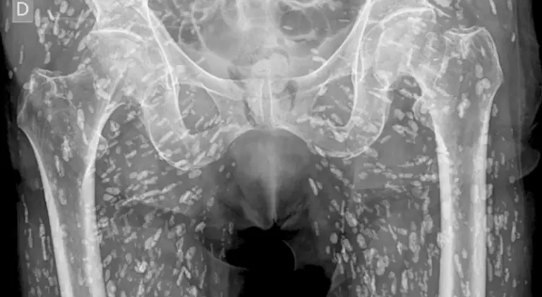 Horrifying X-ray shows tapeworms breeding inside man’s body after he made vital kitchen error
