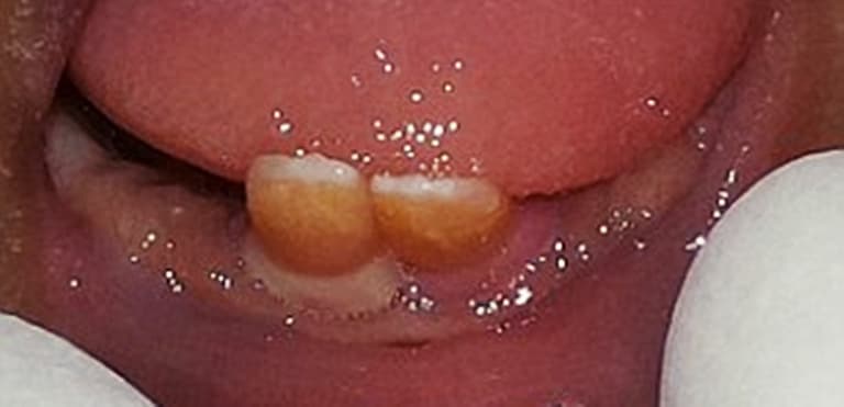 Twins BOTH born with front teeth, breastfeed anyway Twins BOTH born with front teeth, breastfeed anyway