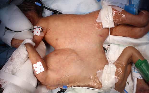 MIRACLE: Youngest Ever Conjoined Twins Separated MIRACLE: Youngest Ever Conjoined Twins Separated