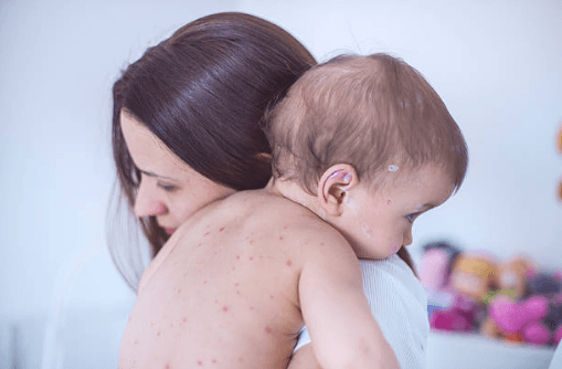 At least 25 cases of measles in the midwest since the start of 2018 At least 25 cases of measles in the midwest since the start of 2018