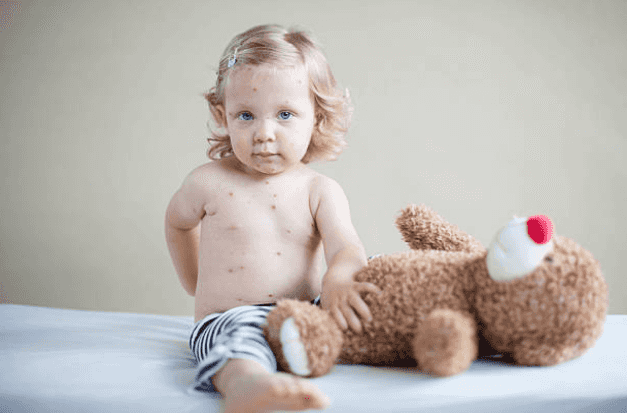 HSE on high alert after measles outbreak discovered in Dublin HSE on high alert after measles outbreak discovered in Dublin