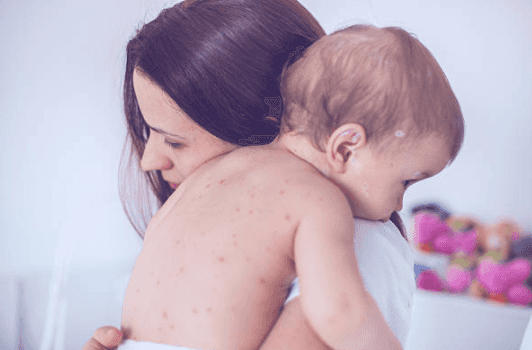 Free vaccines offered in Limerick this week as measles outbreak worsens Free vaccines offered in Limerick this week as measles outbreak worsens