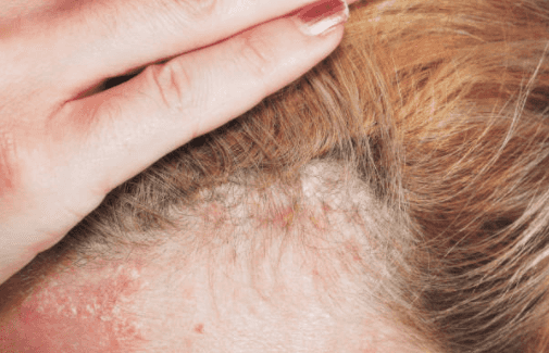 Woman claims her psoriasis disappeared after using €5.30 baby moisturiser Woman claims her psoriasis disappeared after using €5.30 baby moisturiser