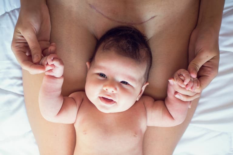 “Stop saying that C-sections are the easy way out!” – a mother’s plea “Stop saying that C-sections are the easy way out!” – a mother’s plea