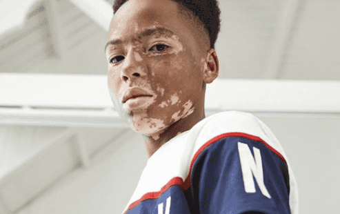 Penneys praised for including teenage model with vitiligo in new campaign Penneys praised for including teenage model with vitiligo in new campaign