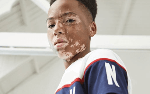 Penneys praised for including teenage model with vitiligo in new campaign Penneys praised for including teenage model with vitiligo in new campaign