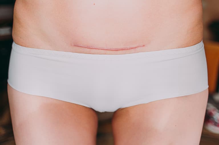 Viral video shows exactly what a person goes through when they have a c-section Viral video shows exactly what a person goes through when they have a c-section