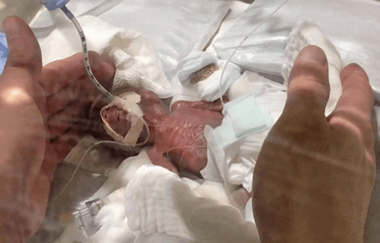 World’s smallest premature baby boy has left hospital healthy World’s smallest premature baby boy has left hospital healthy
