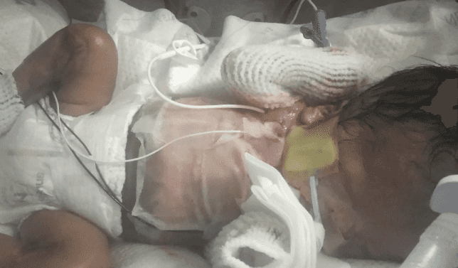 Three-month-old baby born without most of his skin now in stable condition Three-month-old baby born without most of his skin now in stable condition