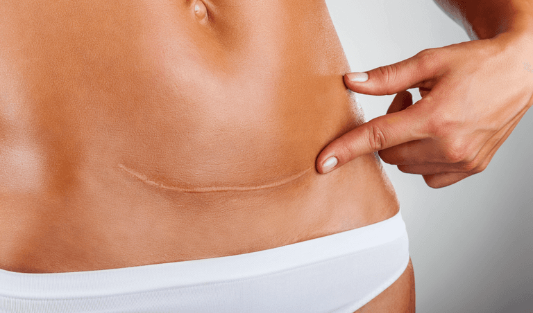 C-section recovery: We asked C-section mums to share their best tips and tricks C-section recovery: We asked C-section mums to share their best tips and tricks