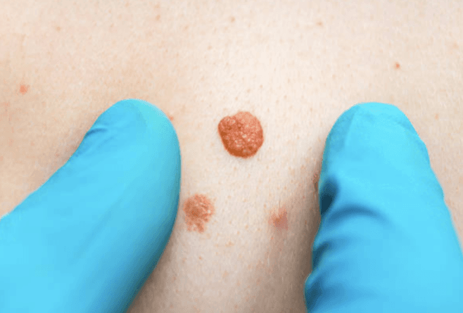Boots now offering crucial mole scanning service in 17 stores nationwide Boots now offering crucial mole scanning service in 17 stores nationwide
