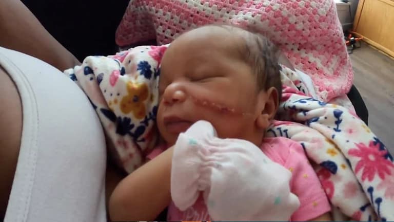 Newborn needs 13 stitches on her face after being “sliced” during emergency C-section Newborn needs 13 stitches on her face after being “sliced” during emergency C-section