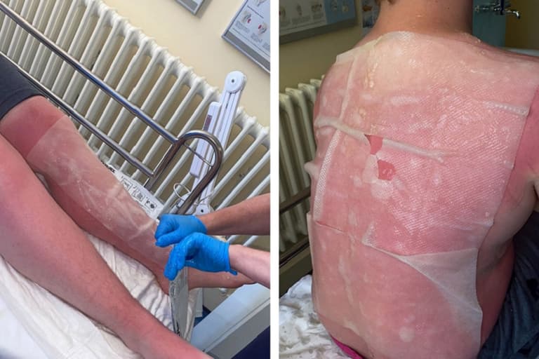 “I am burning from the inside out”: Mum issues stark warning after son suffers extreme sunburn “I am burning from the inside out”: Mum issues stark warning after son suffers extreme sunburn