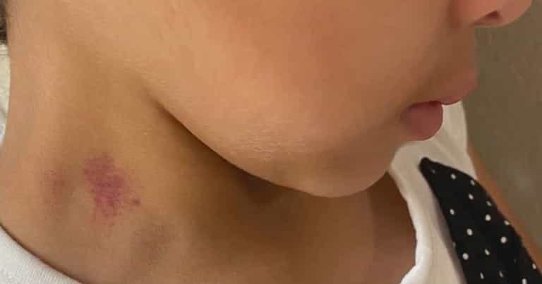 Mum shocked to find hickeys on bullied 6-year-old’s neck after school Mum shocked to find hickeys on bullied 6-year-old’s neck after school