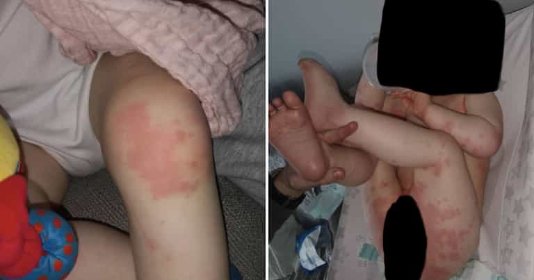 Cork mam warns parents after 1-year-old son is hospitalised with Covid-related rash Cork mam warns parents after 1-year-old son is hospitalised with Covid-related rash