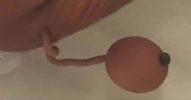 Premature newborn born with human tail Premature newborn born with human tail