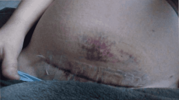 Mum shares photo of C Section scar to prove it is not the ‘easy way out’ Mum shares photo of C Section scar to prove it is not the ‘easy way out’