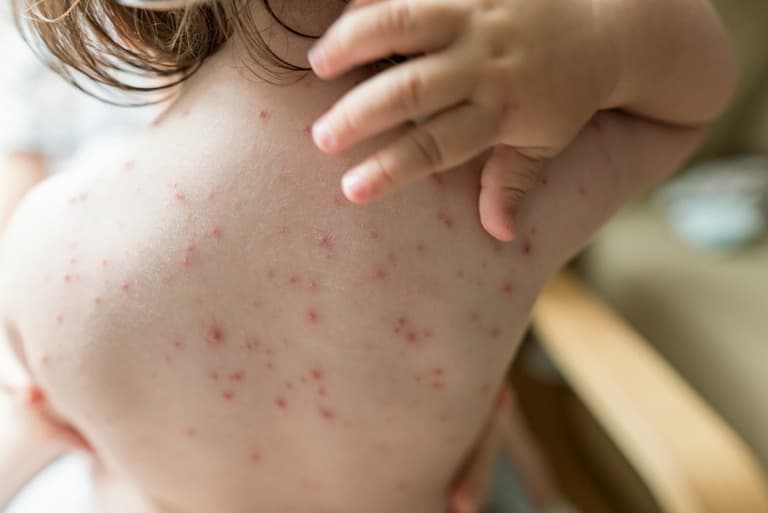 Concerns about increase in chickenpox cases in Ireland Concerns about increase in chickenpox cases in Ireland