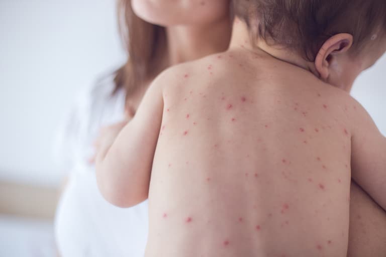 Chickenpox vaccine will likely be added to childhood immunisation programme Chickenpox vaccine will likely be added to childhood immunisation programme