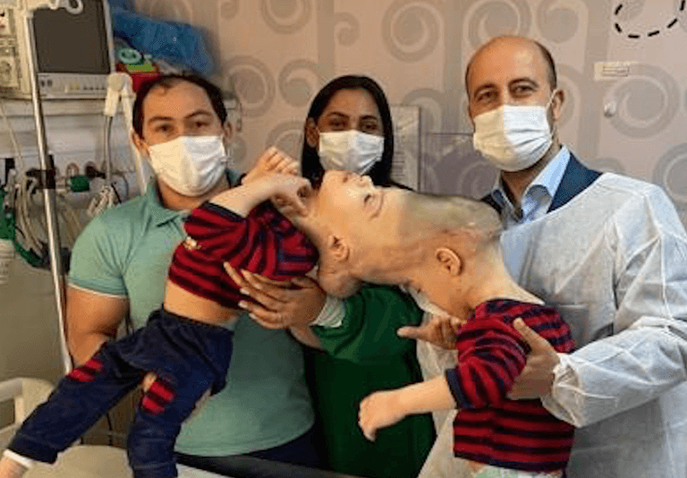 Conjoined twins with fused brains have been successfully separated Conjoined twins with fused brains have been successfully separated