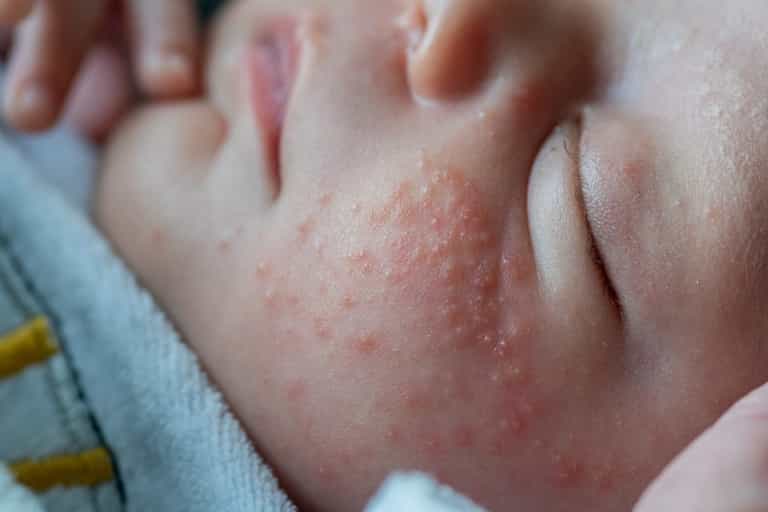 From eczema to nappy rash, baby’s skin is among the top parenting concerns From eczema to nappy rash, baby’s skin is among the top parenting concerns