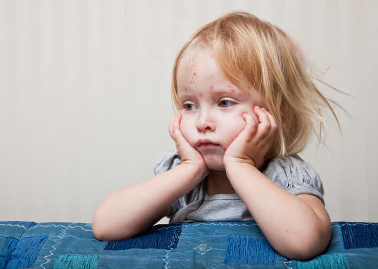 The signs of chickenpox to look out for in kids ‘before the rash appears’ The signs of chickenpox to look out for in kids ‘before the rash appears’