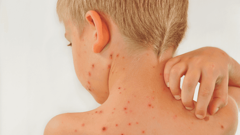 Parents urged to be ‘Chickenpox Aware’ following recent figures Parents urged to be ‘Chickenpox Aware’ following recent figures
