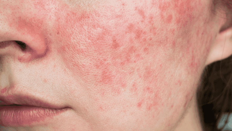 Her Health: HSE issues warning about rosacea triggers Her Health: HSE issues warning about rosacea triggers