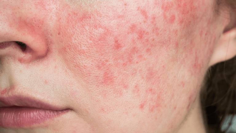 Her Health: HSE issues warning about rosacea triggers Her Health: HSE issues warning about rosacea triggers