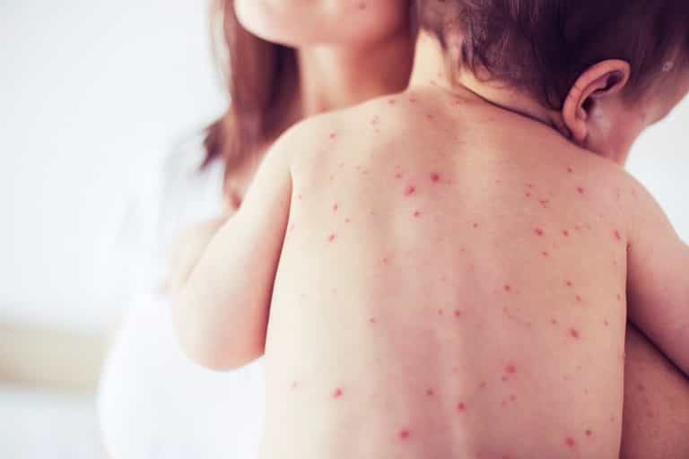 ALERT: 22 People Hit By Measles Outbreak, All Aged Under 30 ALERT: 22 People Hit By Measles Outbreak, All Aged Under 30