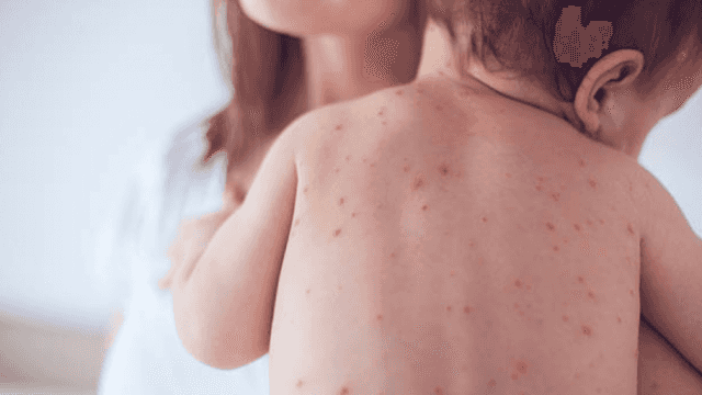 18 of the 20 diagnosed in Limerick’s measles outbreak were unvaccinated 18 of the 20 diagnosed in Limerick’s measles outbreak were unvaccinated