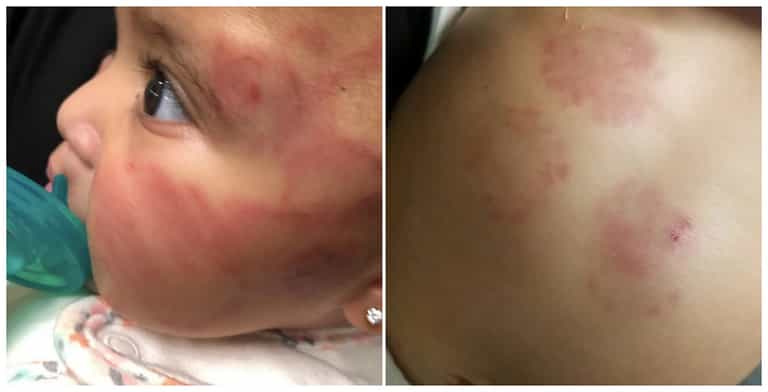 6-month-old baby left ‘covered in bruises’ after being alone with older child at creche 6-month-old baby left ‘covered in bruises’ after being alone with older child at creche