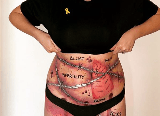 Irish singer RuthAnne shines a light on endometriosis with a powerful bodypaint picture Irish singer RuthAnne shines a light on endometriosis with a powerful bodypaint picture