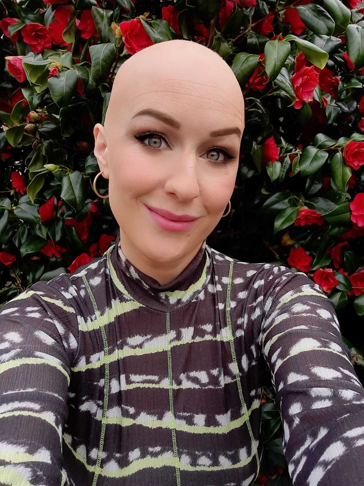 It changed my relationship with beauty: journalist Mary Cate Smith discusses her alopecia journey