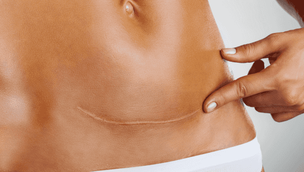 C-section shaming is a thing – and if it has happened to you, you will feel this C-section shaming is a thing – and if it has happened to you, you will feel this