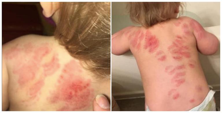Horrified mum discovers her toddler is covered in bitemarks after a day in creche Horrified mum discovers her toddler is covered in bitemarks after a day in creche