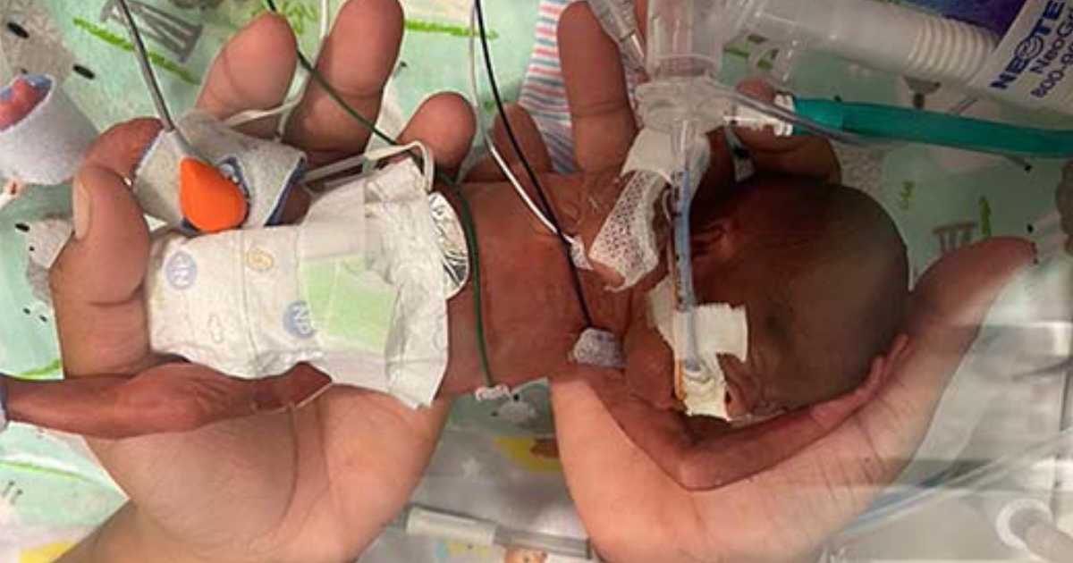 Tiny baby born in 2020 named the world’s most premature to survive