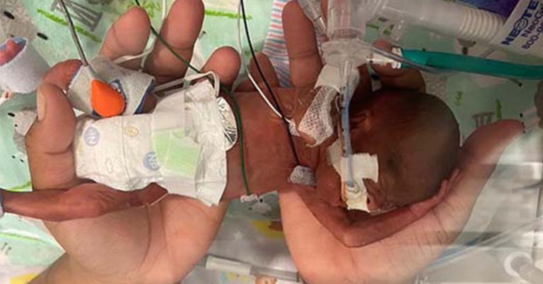 Tiny baby born in 2020 named the world’s most premature to survive Tiny baby born in 2020 named the world’s most premature to survive