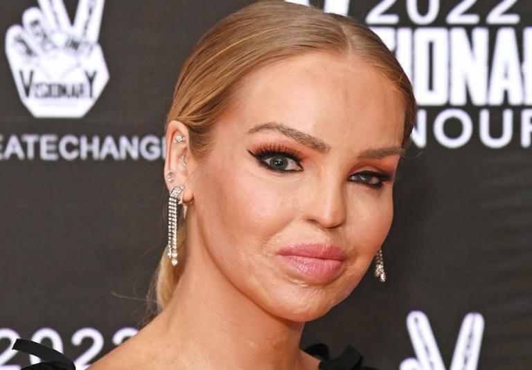 “My old face was removed”: Katie Piper opens up about having her face reconstructed “My old face was removed”: Katie Piper opens up about having her face reconstructed