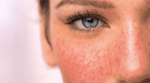 Rosacea awareness month: 3 skincare products many rosacea sufferers swear by Rosacea awareness month: 3 skincare products many rosacea sufferers swear by