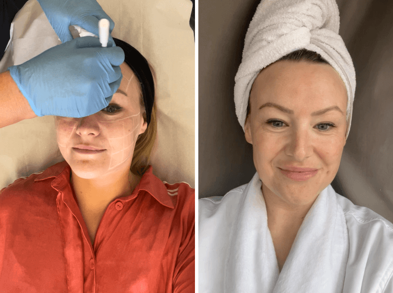 Tweakments: Everyone’s getting Belotero Revive, but what is it? Tweakments: Everyone’s getting Belotero Revive, but what is it?