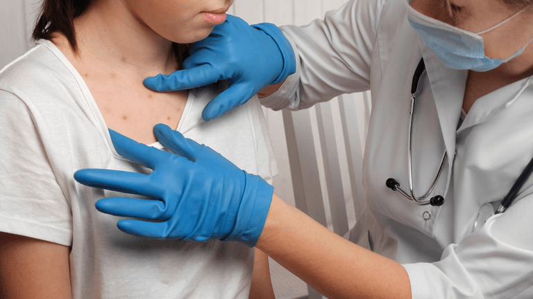 Outbreak of measles in the UK – the main symptoms to look out for Outbreak of measles in the UK – the main symptoms to look out for