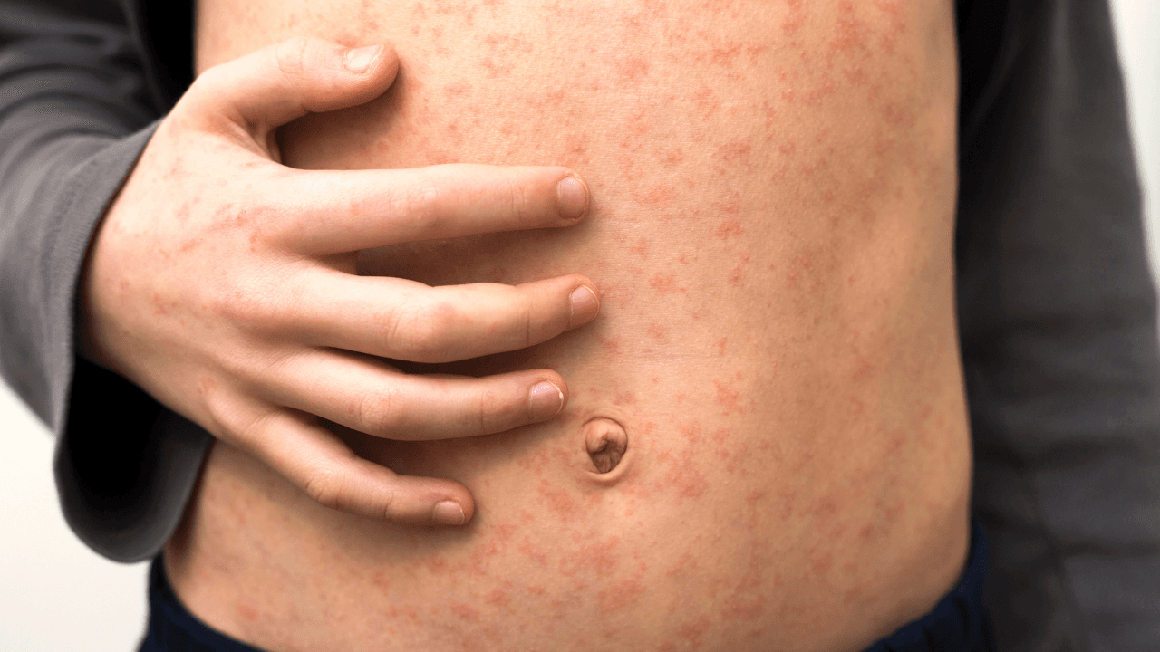 Measles: Latest report shows increase of possible cases in Ireland last week
