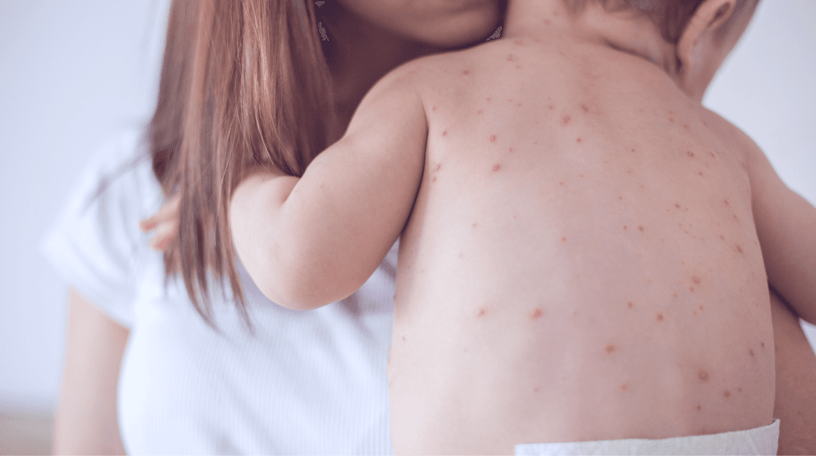 Warning issued after suspected case of measles at Dublin creche