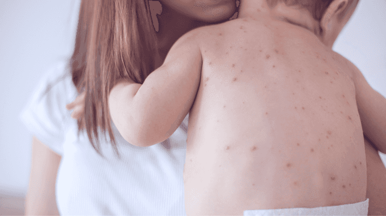 Warning issued after suspected case of measles at Dublin creche Warning issued after suspected case of measles at Dublin creche