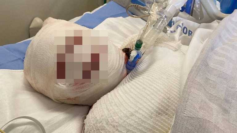 Woman’s face ‘falls off’ after horrific reaction to taking ibuprofen Woman’s face ‘falls off’ after horrific reaction to taking ibuprofen