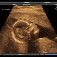 Ultrasound scan images reveal harmful effects of smoking during pregnancy