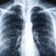 Hundreds of patients recalled after X-ray errors
