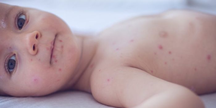 measles vaccinations immunisation anti-vaxxers